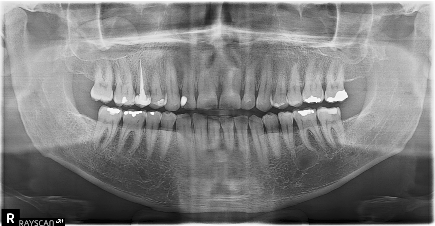 Radiology Case - Mandibular Molar